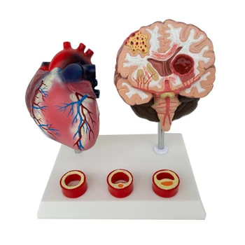 Демонстрационная модель патологического цереброваскулярного заболевания при закупорке сердечно-сосудистой системы человека и сосудов головного мозга
